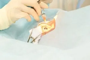 tecnologias para cirujia refractiva